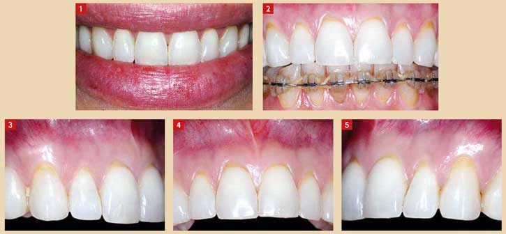 récessions-gingivales