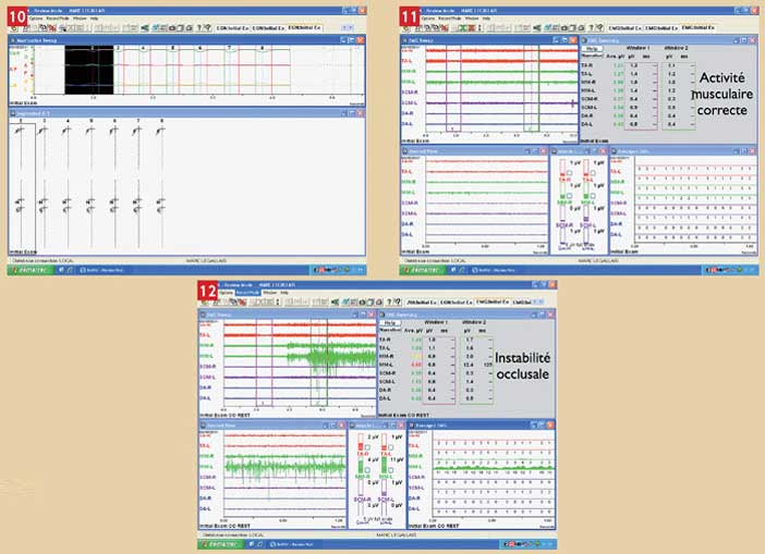 analyse-occlusion-dentaire