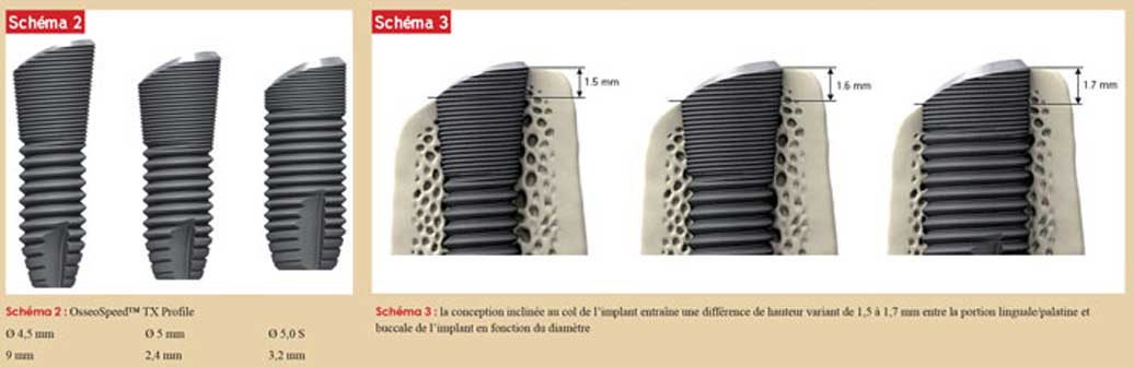 conception-et-placement-de-l-implant