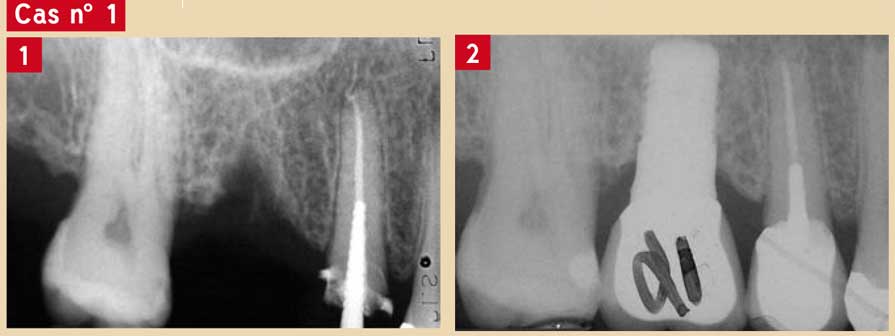 implant-avec-hexagone-interne