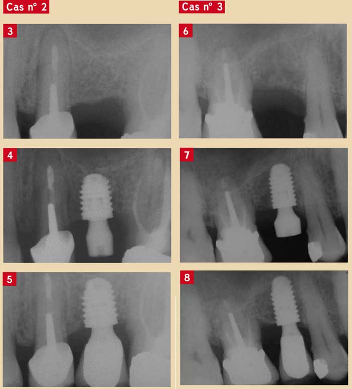 implants-courts