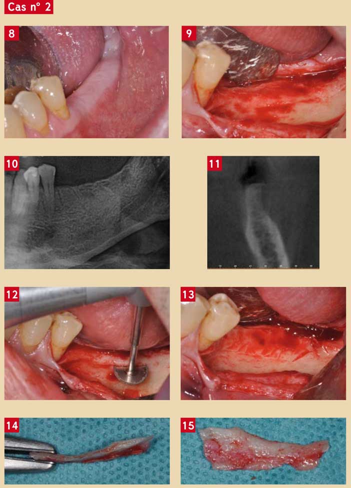 incision-en-muqueuse