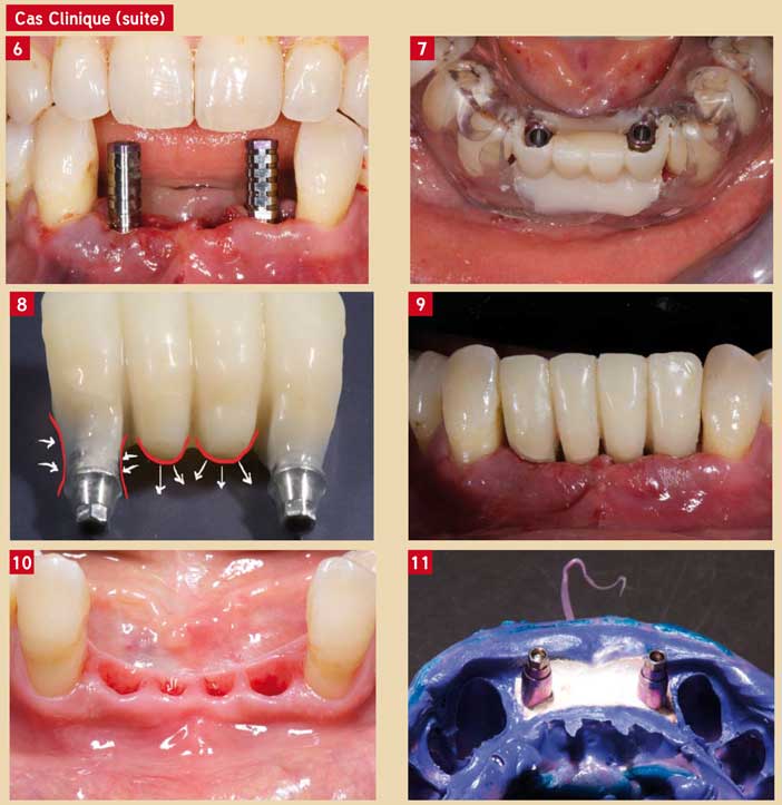 la-position-de-l’implant