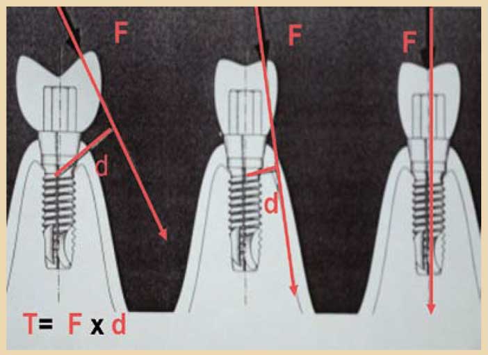 le-centre-de-gravité-de-l-implant