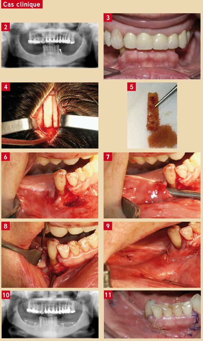 revascularisation-périostée