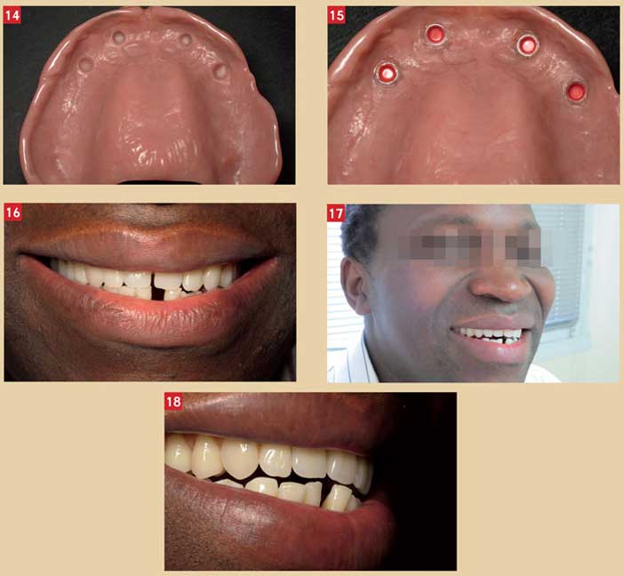 sourire-post-operatoire