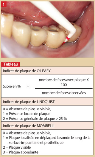 analyse-des-tissus-peri-implantaires