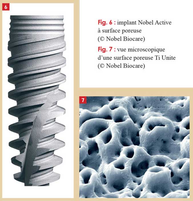 Implant-nobel-active