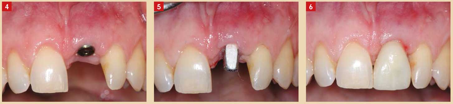 Respect-de-la-zone-C-(cervicale)-par-mise-en-place-immédiate-d’implants-après-extraction