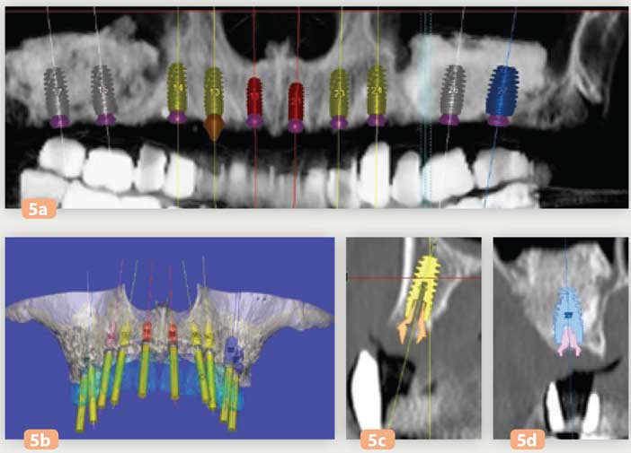 planification-des-implants