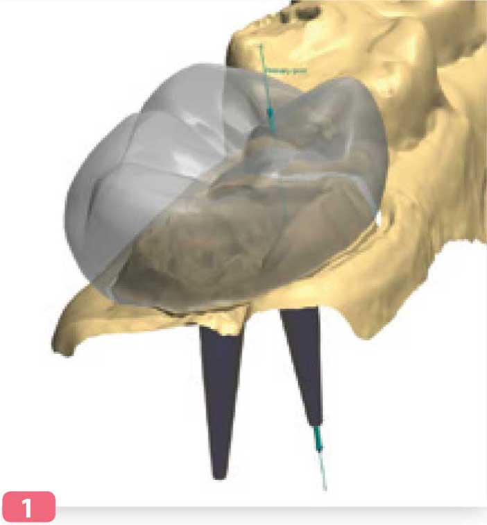 simulation-d-une-couronne