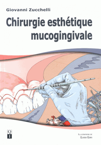 Chirurgie esthétique mucogingivale