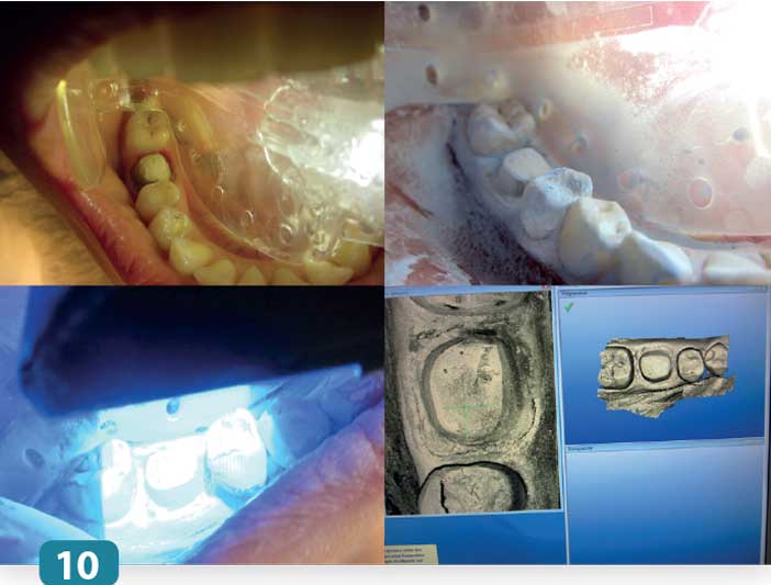 empreinte-optique-au-CEREC