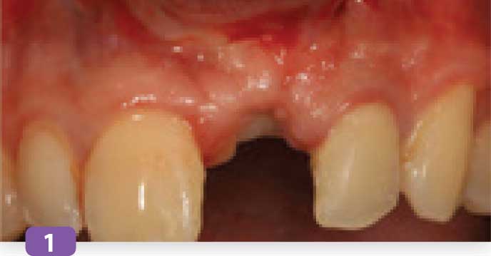 extraction-implantation