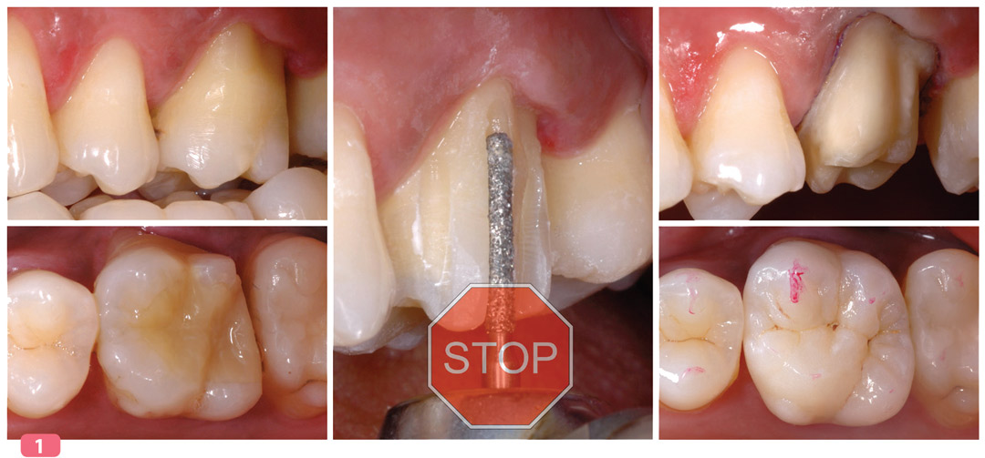 restaurer-sans-tenon-et-sans-couronne