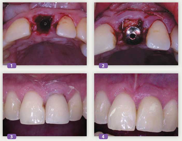 apport-de-conjonctif-lors-dune-extraction-implantation-immediate