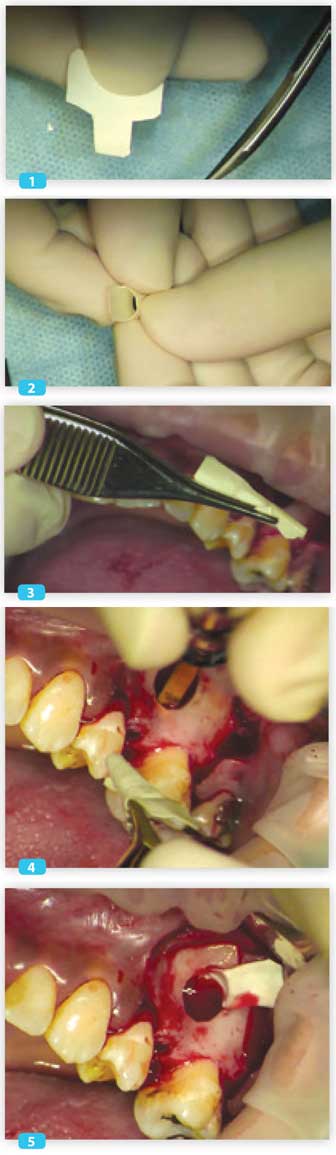 étape-finale-sinus-lift