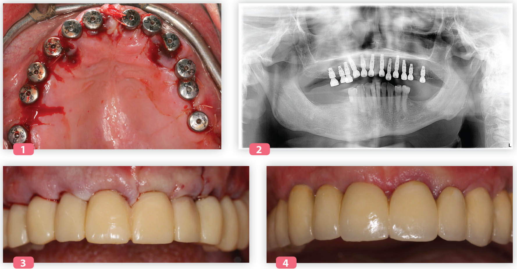 L’implant Naturactis