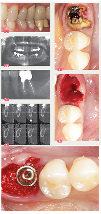 Extraction implantation et provisoire immédiates