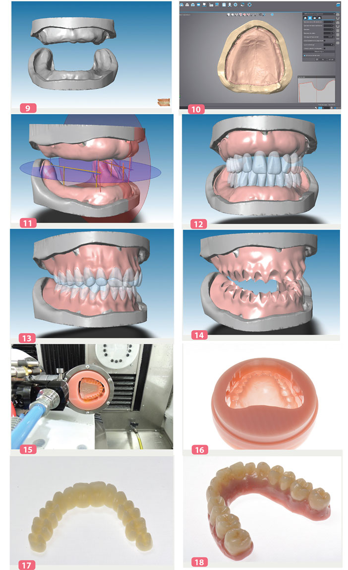 Prothèse Amovible Complète et CFAO