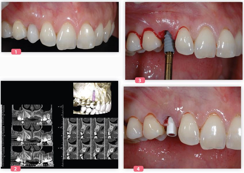 cas clinique implant et canine incluse