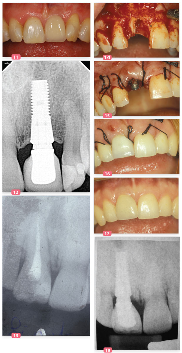 fracture radiculaire