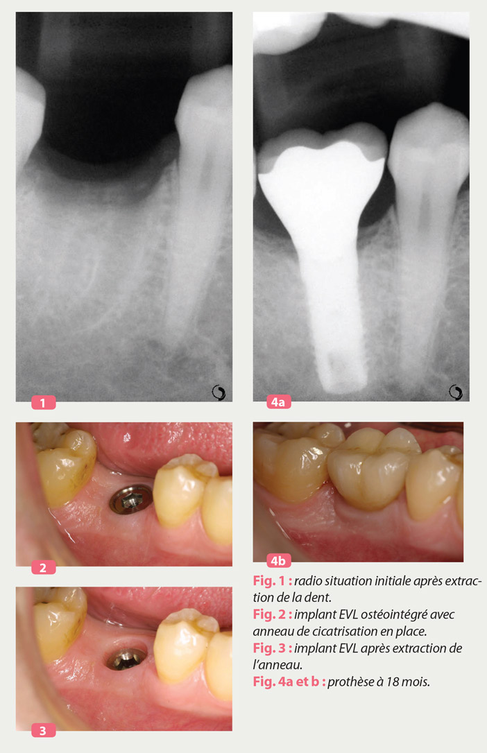 implant evl osteointegre anneau de cicatrisation