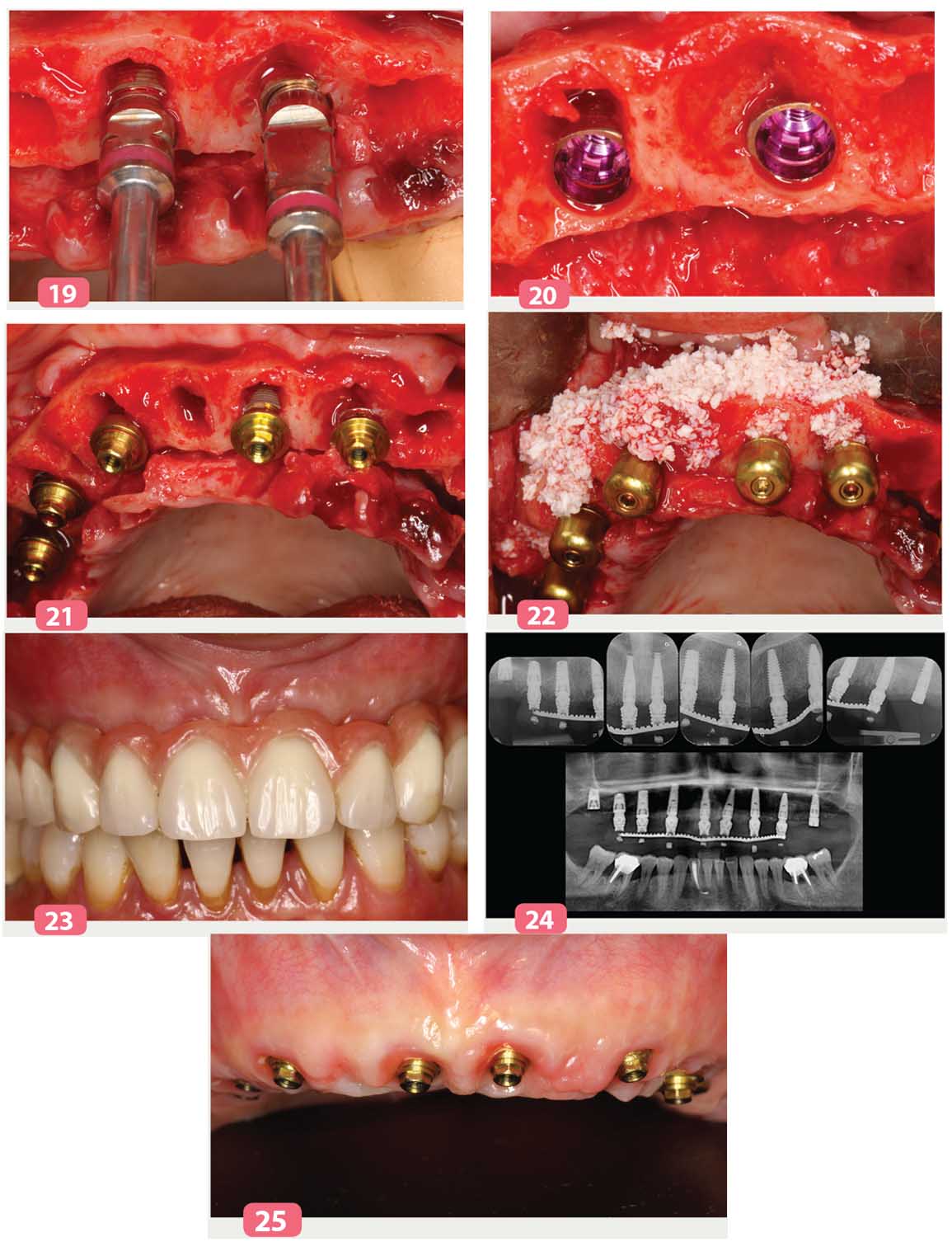 implants C1 et V3