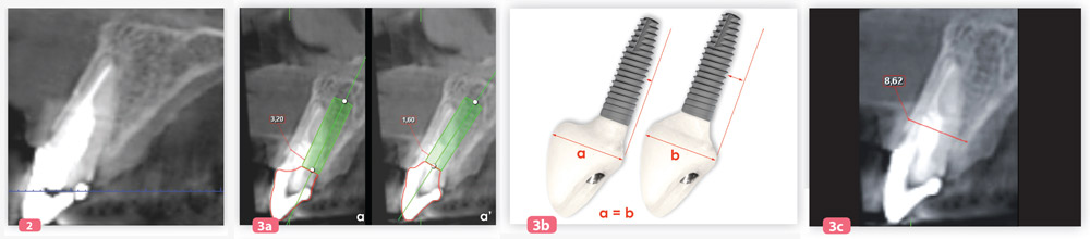 position-de-rehabilitation-dent-implant