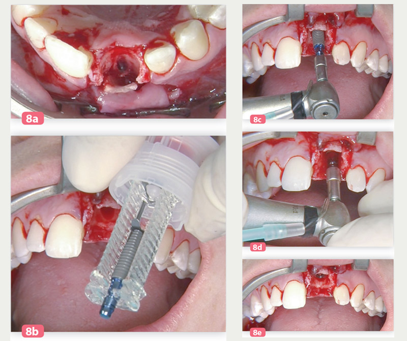 position-distalee-de-implant