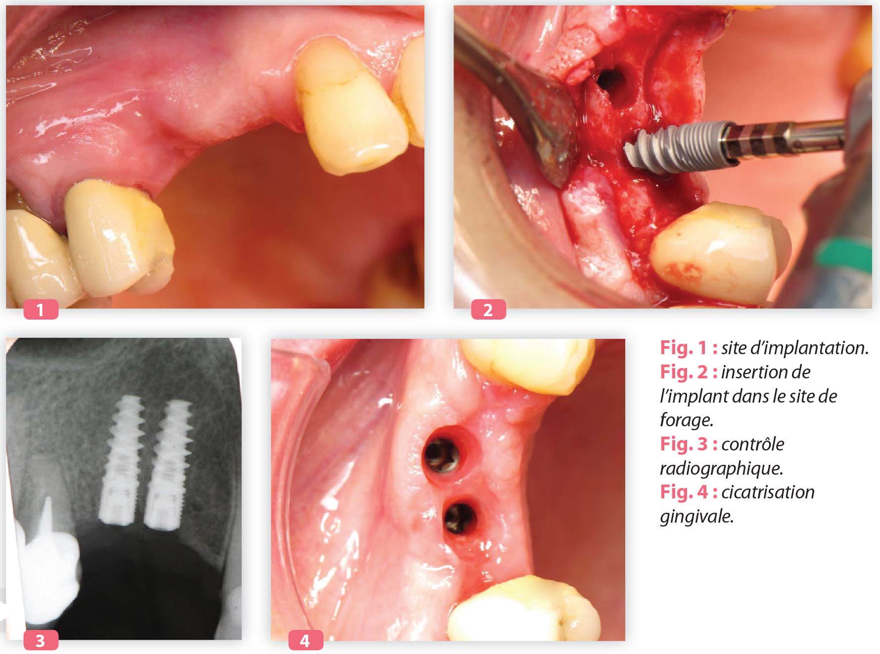 L’implant Naturactis