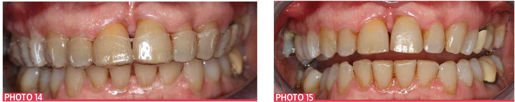 APRÈS-TRAITEMENT-ORTHODONTIQUE