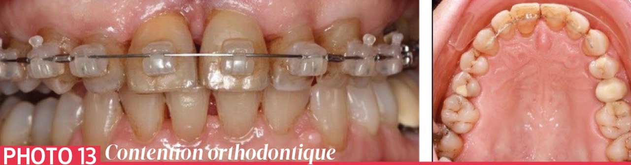 Contention-orthodontique