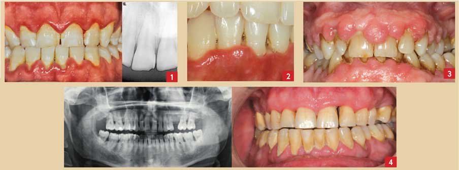 Les-pathologies-parodontales