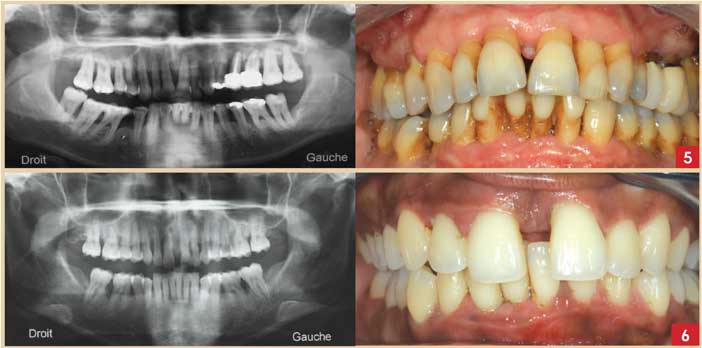 parodontite-chronique-généralisée