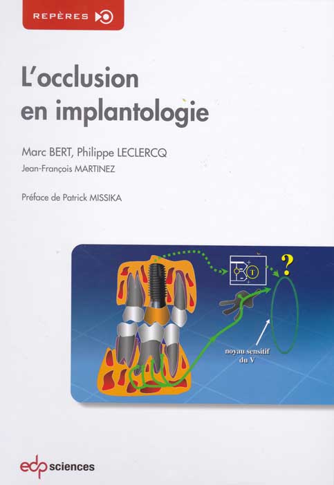 L-OCCLUSION-EN-IMPLANTO