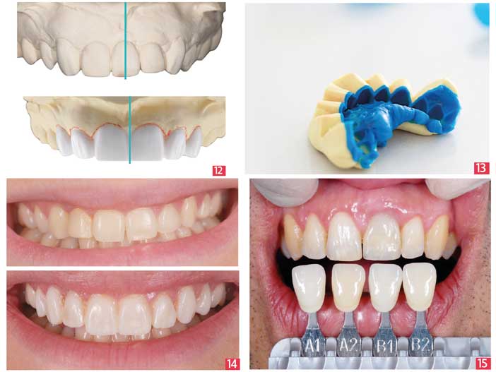 les-volumes-des-dents