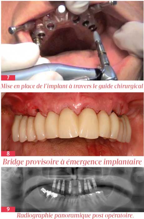 Mise-en-place-de-l’implant