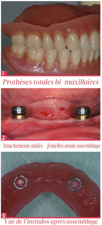 Prothèses-totales-bi-maxillaires