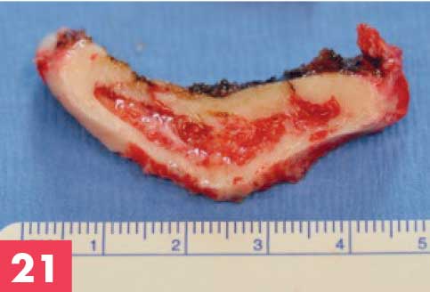 Tranche-de-génioplastie