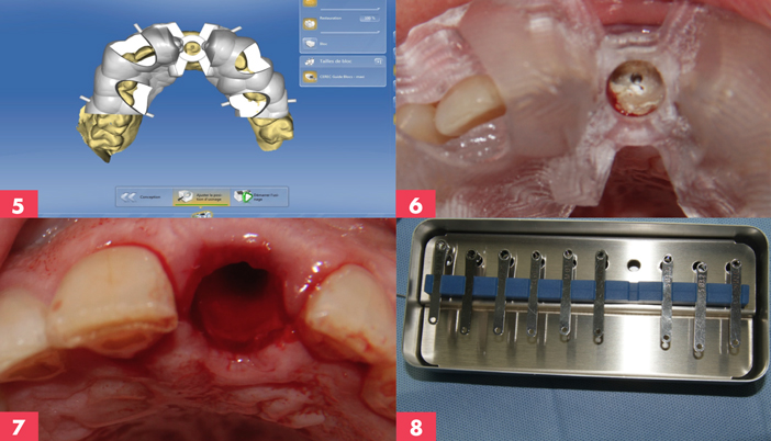 guide-chirurgical-modelise