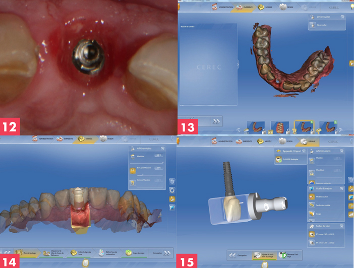 profil-gingival-amenage