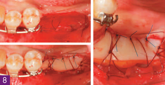 greffe-gingivale