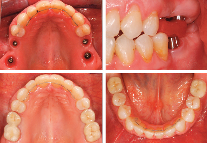 prothese-d-usage