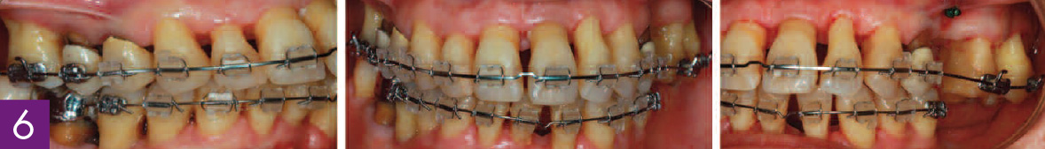 traitement-orthodontique