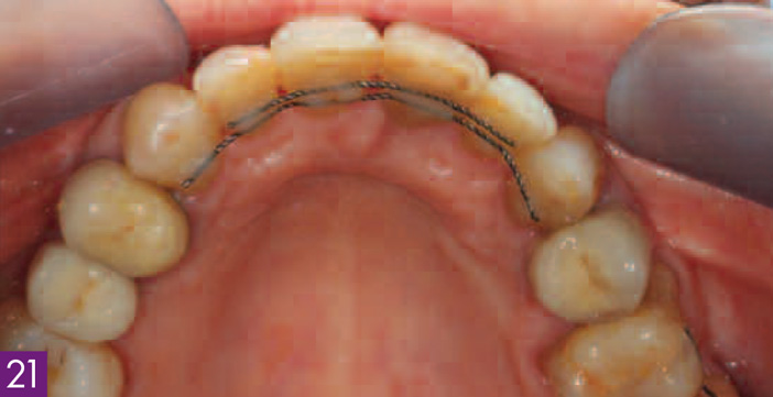 contention-orthodontique