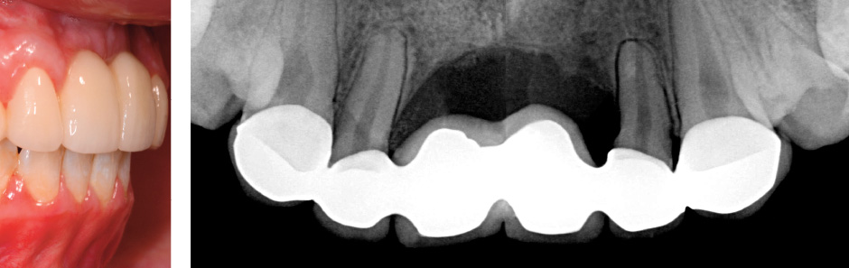 controle-gingival-et-prothetique