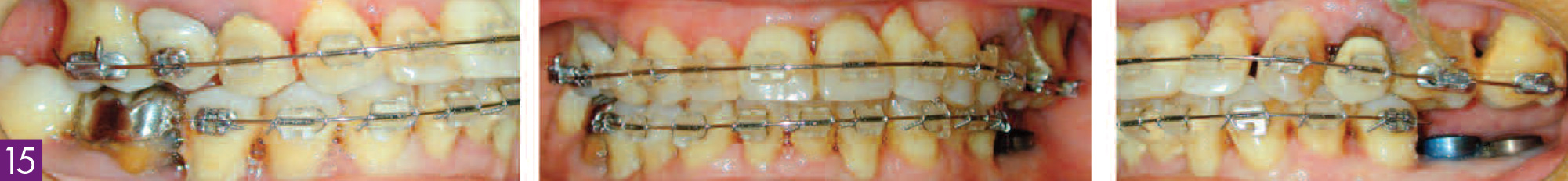fin-de-traitement-orthodontique