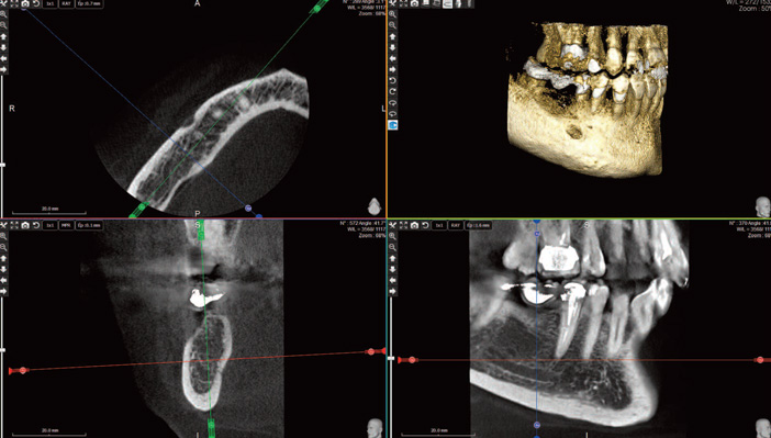 traitement-endodontique