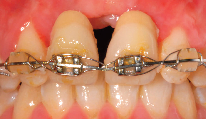 traitement-orthodontique